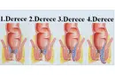 4 Derece Hemoroid Belirtileri ve Tedavisi