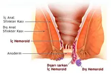 Hemoroid Memesi Nasıl Geçer?