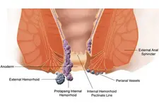 Hemoroid Sıcak Suyun Etkisi