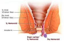 Makatta Hemoroid Belirtileri ve Tedavisi
