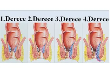 Basur Hemoroid Belirtileri ve Tedavisi
