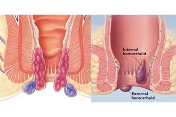 Dış Hemoroid Kanaması Belirtileri ve Tedavisi