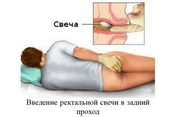 Hemoroid Başlangıcı Belirtileri ve Tedavisi