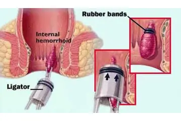 Hemoroid Evreleri Nelerdir?